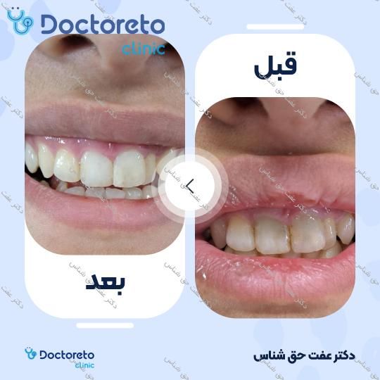 جرم گیری دندان با بروساژ 🦷