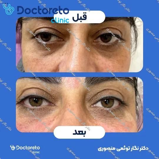 تزریق ژل زیر چشم