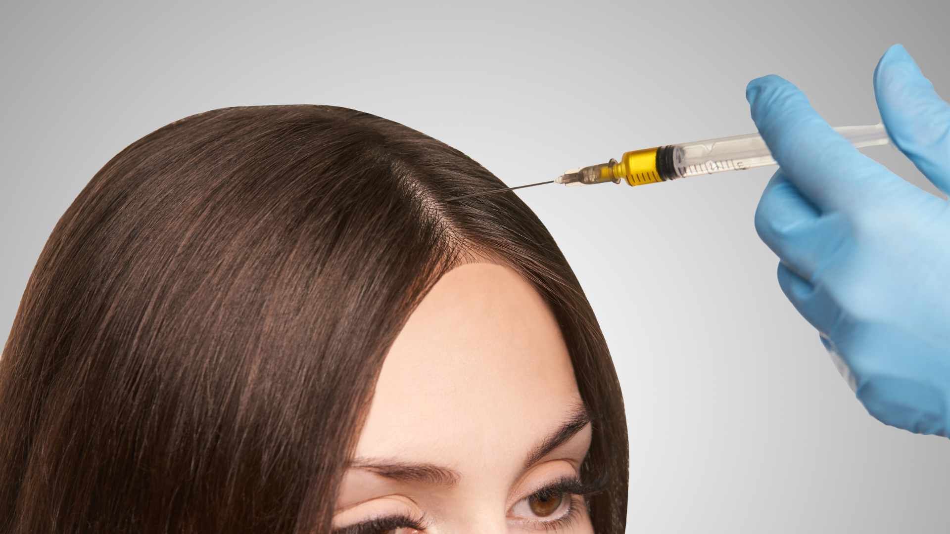 درمان ریزش موی سر با اگزوزوم تراپی