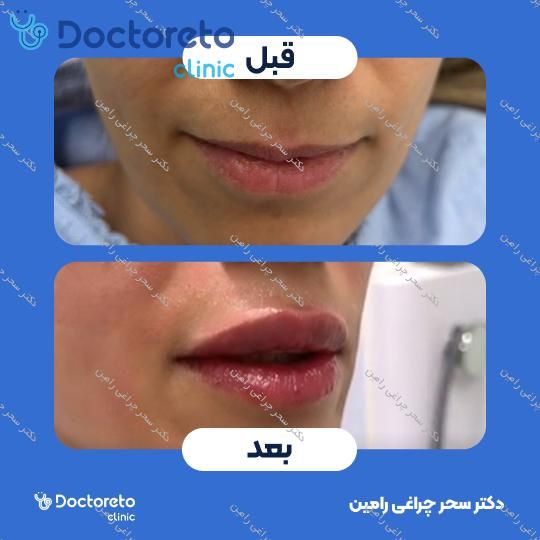 تزریق ژل لب
