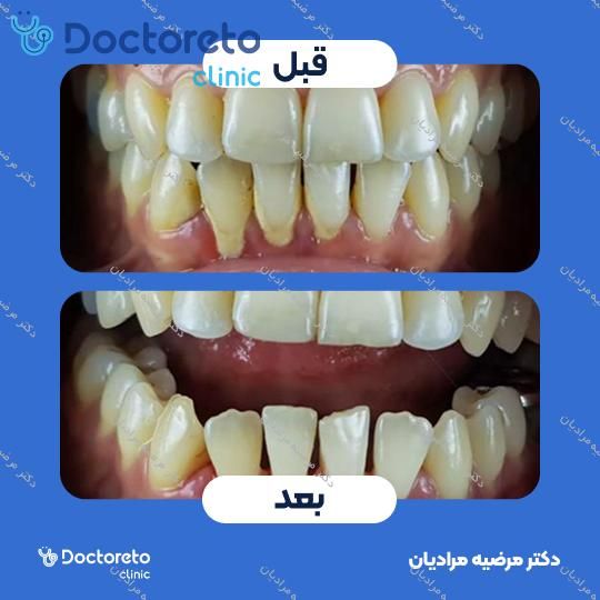 جرم گیری دندان با بروساژ🦷