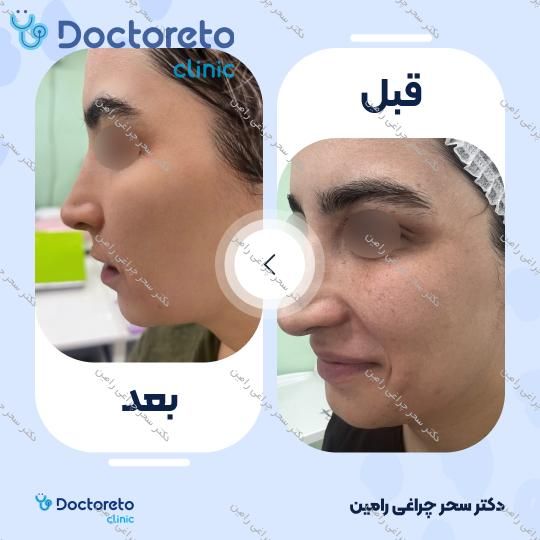 درمان جای جوش و منافذ باز پوست با دستگاه آر اف فرکشنال (هر جلسه)