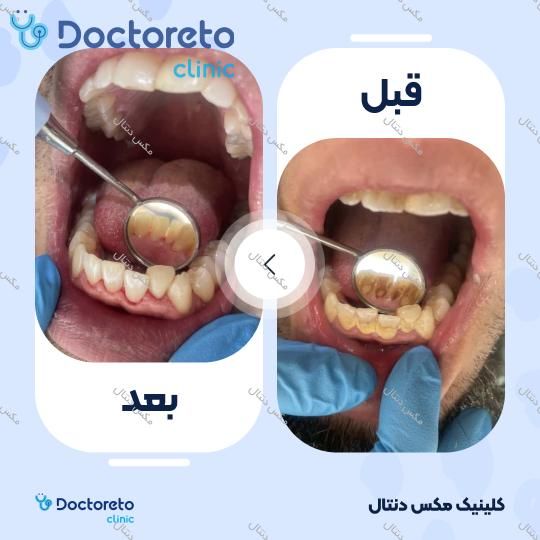 جرم گیری دندان با بروساژ🦷