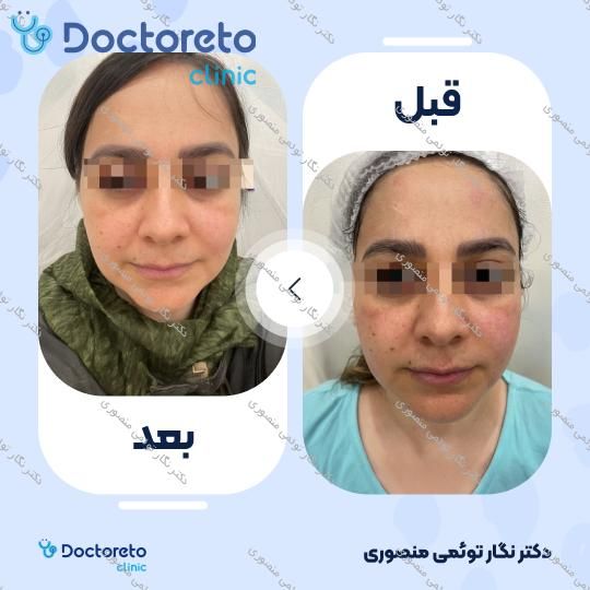 هایفوتراپی صورت، گردن و غبغب با دستگاه اولترا (1 جلسه)