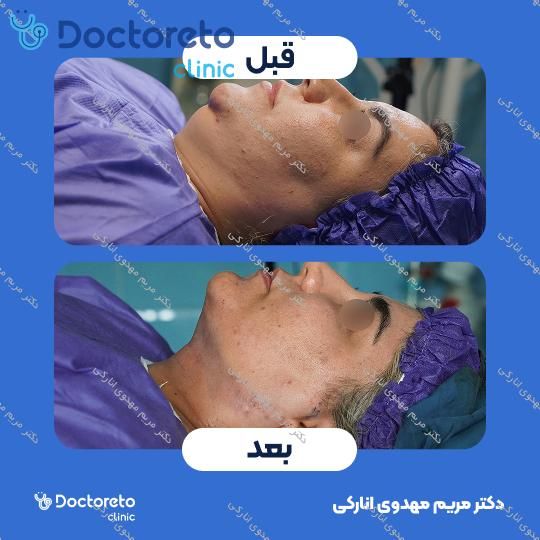 رفع غبغب به روش ساکشن