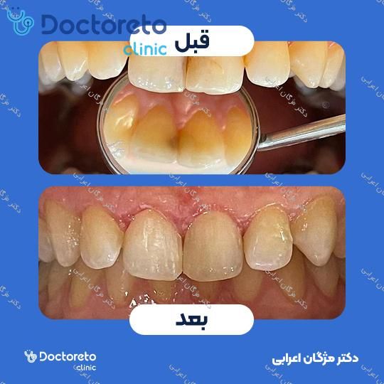 جرم گیری دندان با بروساژ🦷