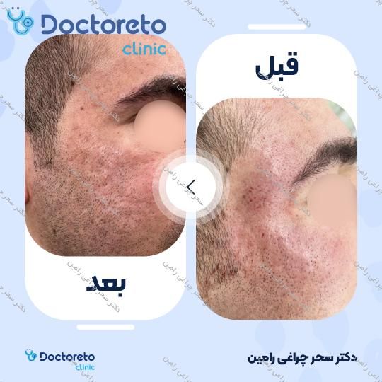 درمان ترک های پوستی و سفت کردن پوست با دستگاه آر اف فرکشنال (هر جلسه)