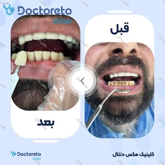 جرم گیری دندان با بروساژ🦷