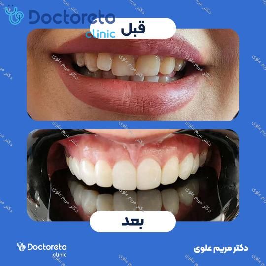 جرم گیری دندان با بروساژ🦷