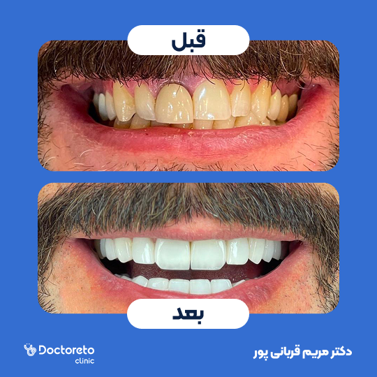 ترمیم کامپوزیت