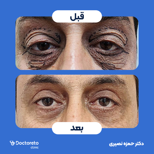 رفع افتادگی پلک پایین به روش خارج پلکی (بلفاروپلاستی)