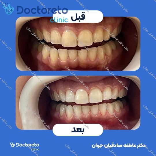 جرم گیری دندان با بروساژ🦷