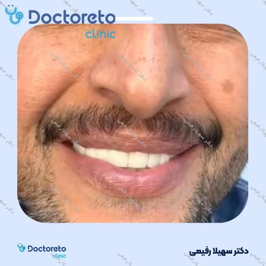 جرم گیری دندان با بروساژ 🦷
