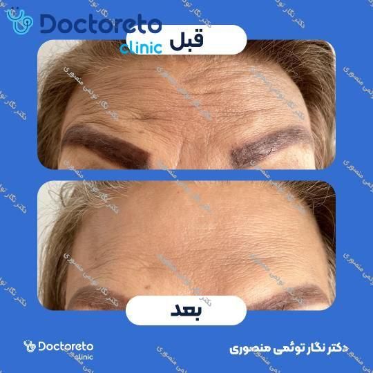 تزریق بوتاکس صورت