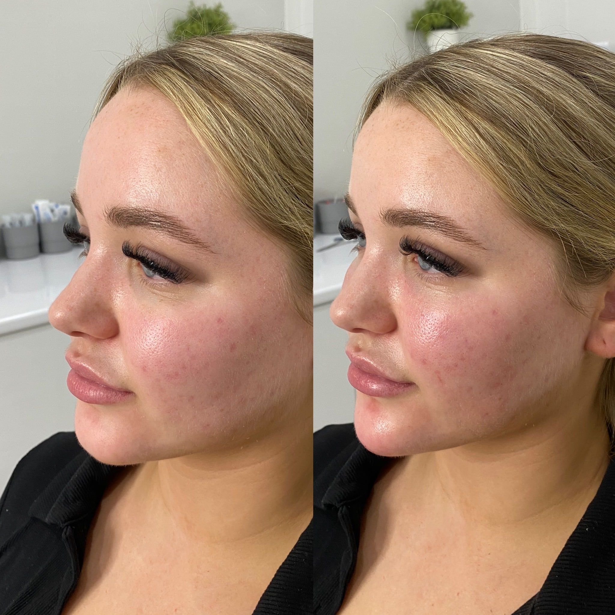 تزریق ژل چانه