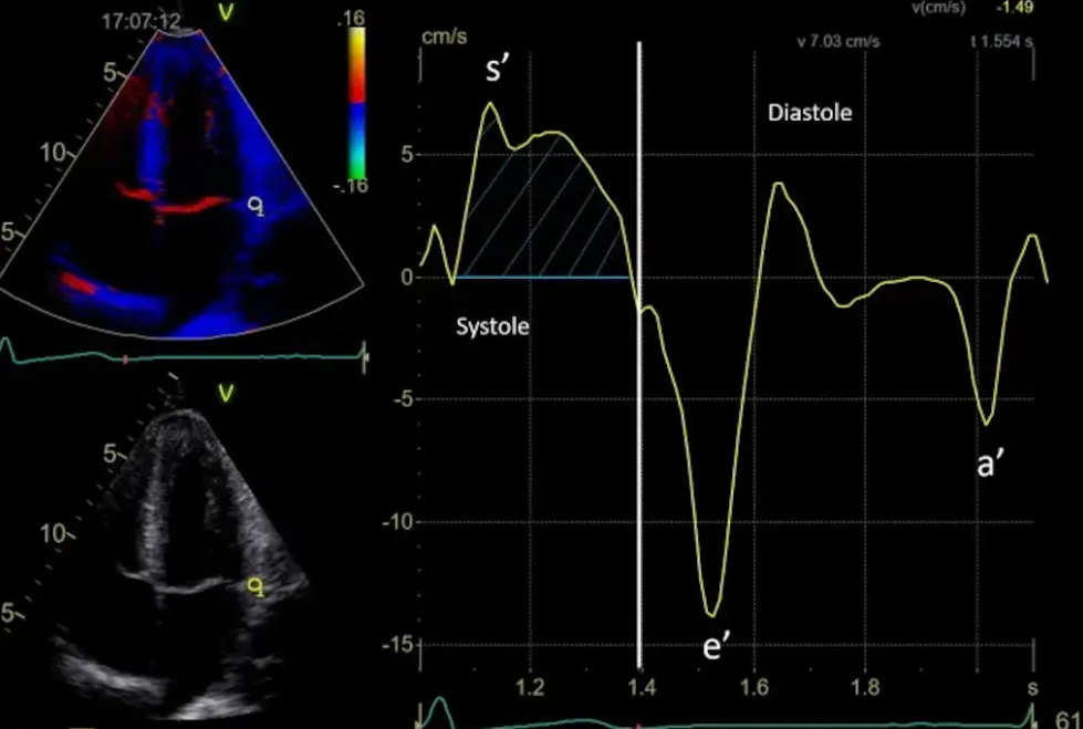 اکوکاردیوگرافی فوق تخصصی به روش تیشو (TDI)