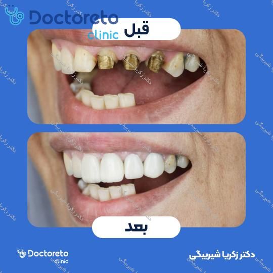 لمینت دندان (هر واحد)