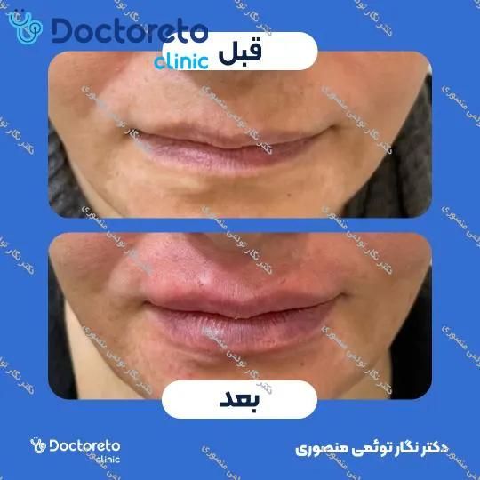 تزریق ژل لب