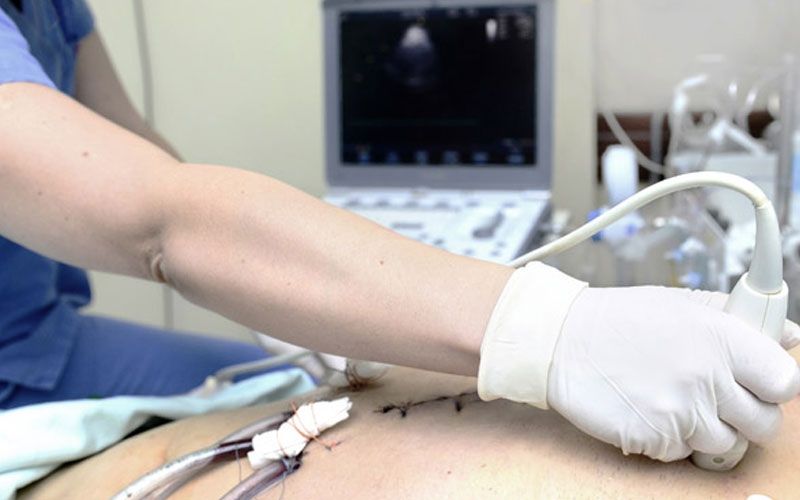 اکو کاردیوگرافی داپلر رنگی