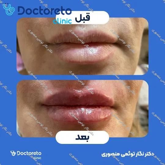 تزریق ژل لب