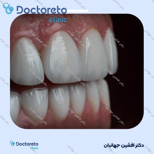 روکش دندان (هر واحد)