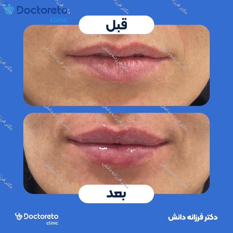 تزریق ژل لب