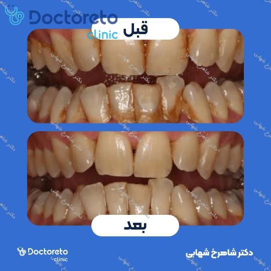 جرم گیری دندان با بروساژ🦷