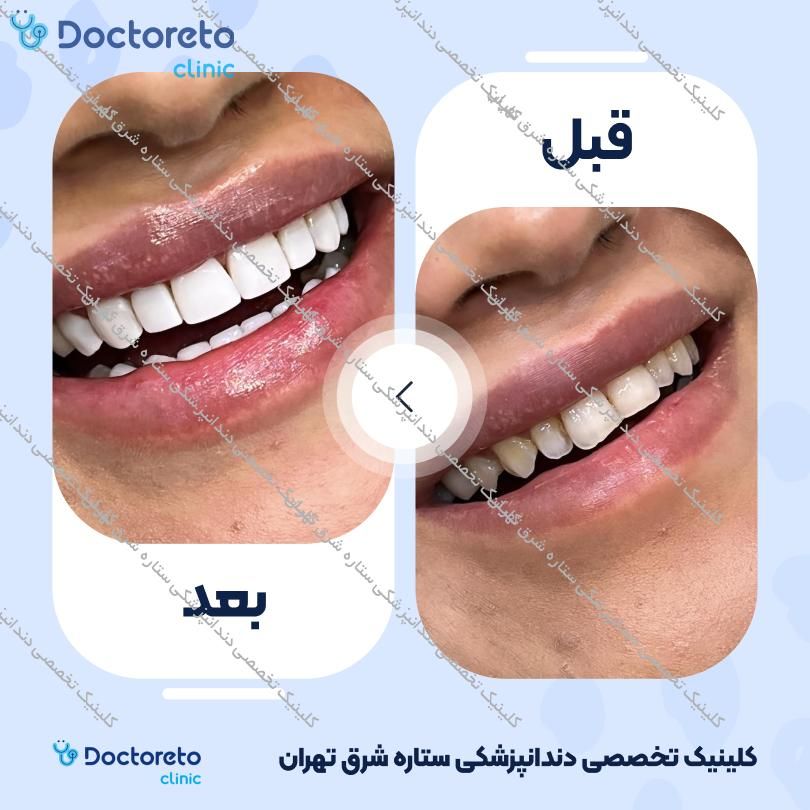 روکش دندان (هر واحد)