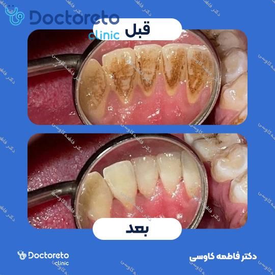 جراحی پیوند استخوان (هر واحد)