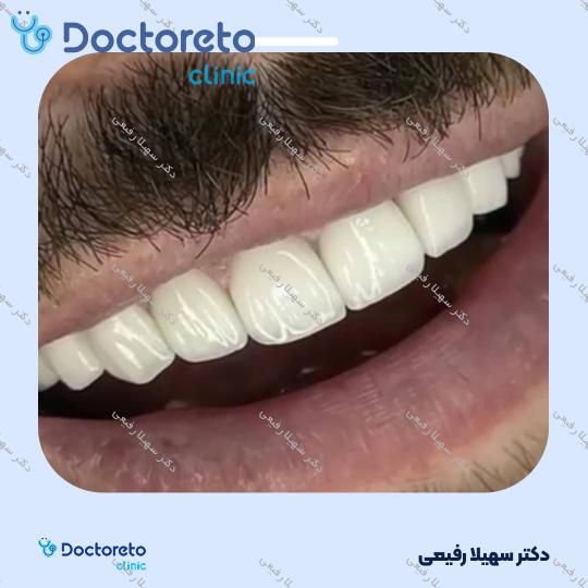 جرم گیری دندان با بروساژ 🦷