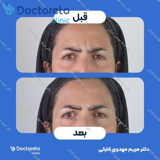 تزریق بوتاکس صورت