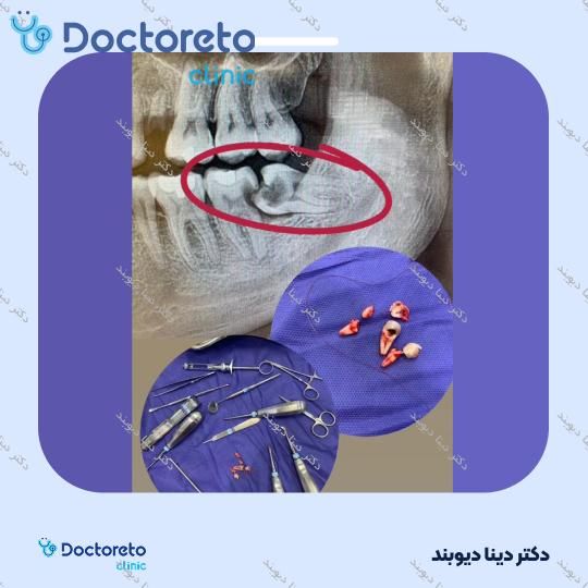 پرکردن دندان