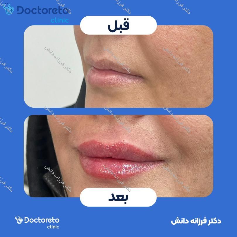 تزریق ژل لب