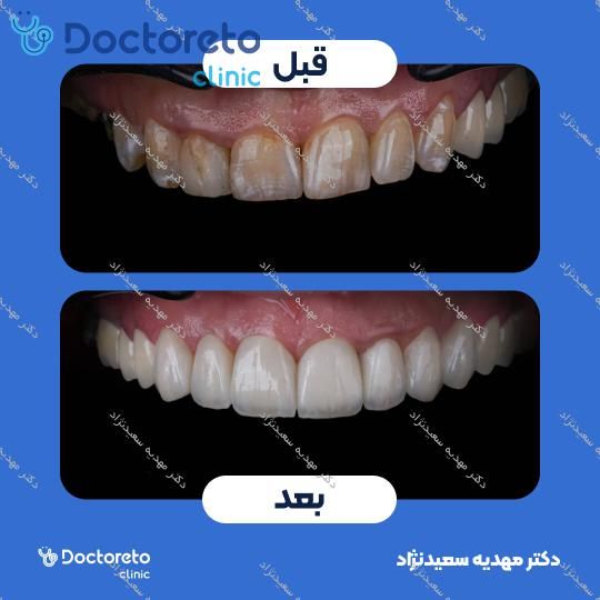 لمینت سرامیکی ایمکس آلمانی (هر واحد)