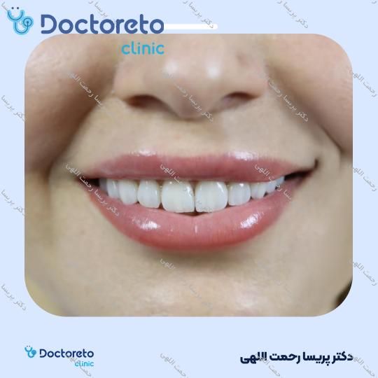 ونیر کامپوزیت توکویاما ژاپنی (هر واحد)