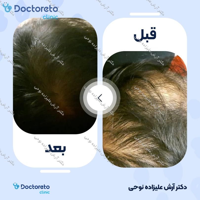 تزریق مزوتراپی مو جهت قطع ریزش مو