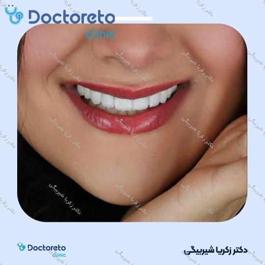 لمینت دندان (هر واحد)