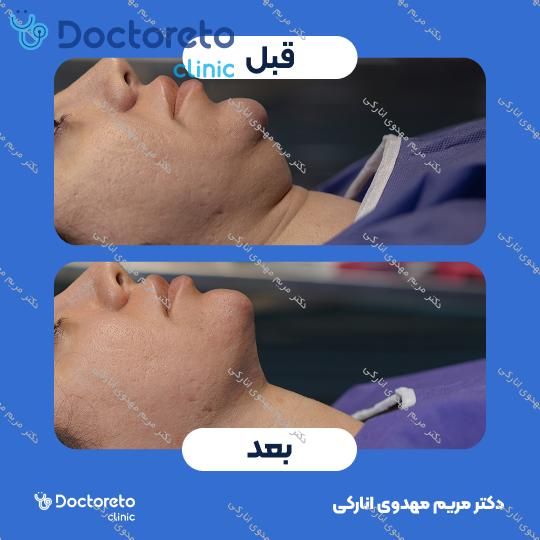 رفع غبغب به روش ساکشن