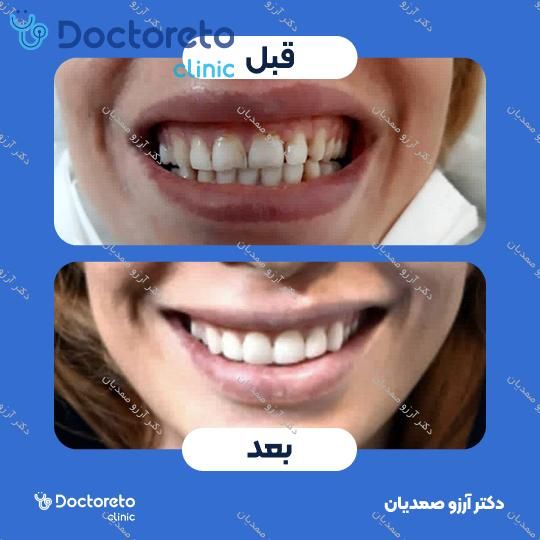 جرم گیری دندان با بروساژ 🦷