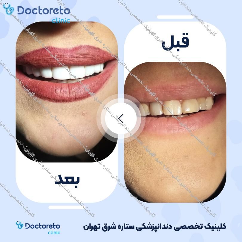 روکش دندان (هر واحد)