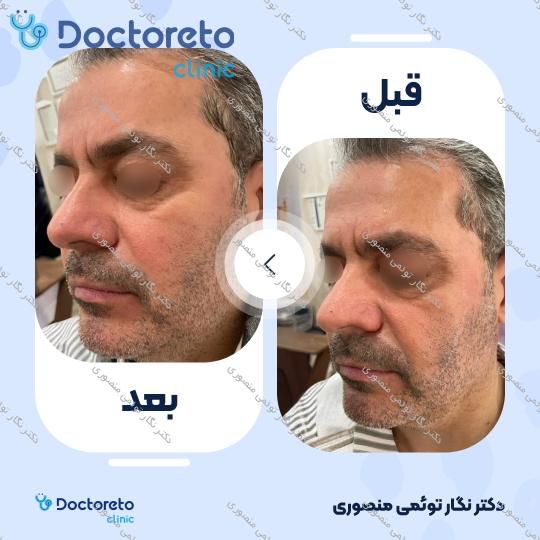 هایفوتراپی