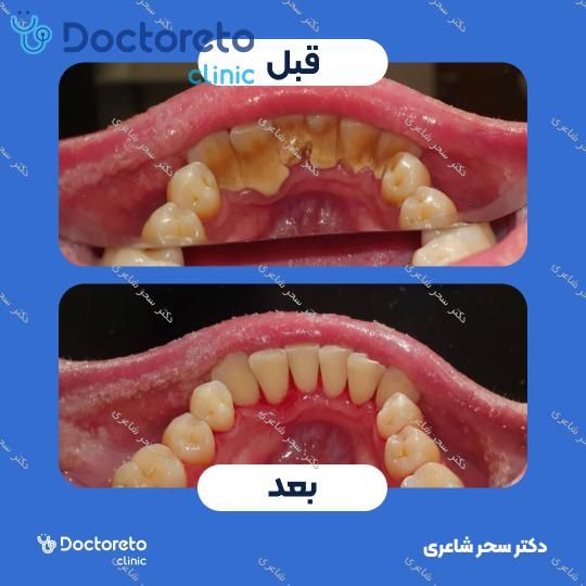 جرم گیری دندان با بروساژ🦷