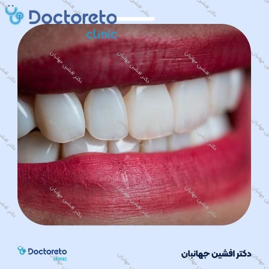 روکش دندان (هر واحد)