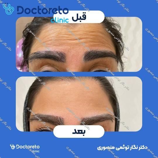 تزریق بوتاکس صورت