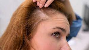 پکیج درمانی ریزش موی سر