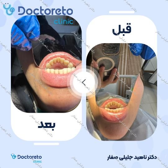 جرم گیری دندان با بروساژ🦷