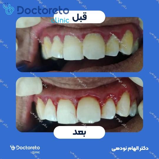 جرم گیری دندان با بروساژ🦷