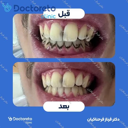 جرم گیری دندان با بروساژ 🦷