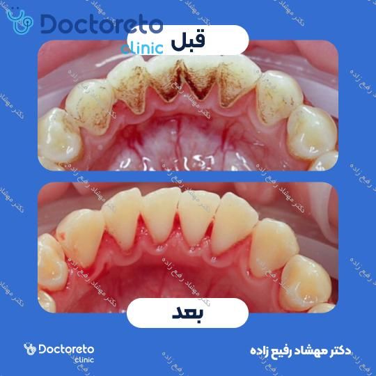 جرم گیری دندان با بروساژ🦷