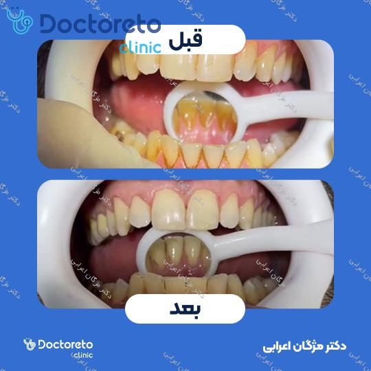 جرم گیری دندان با بروساژ🦷
